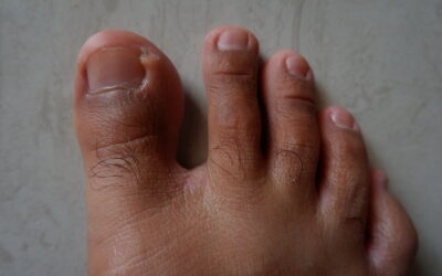 Swelling and Oedema
